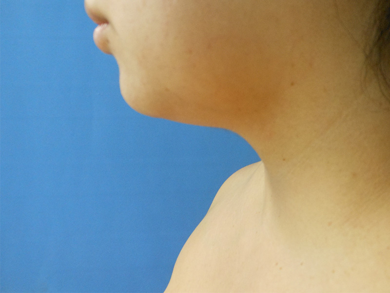 Side profile of a person's neck and chin against a blue background