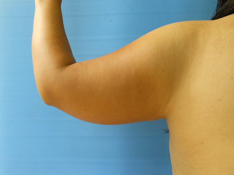 A close-up of a bare arm and shoulder against a blue background