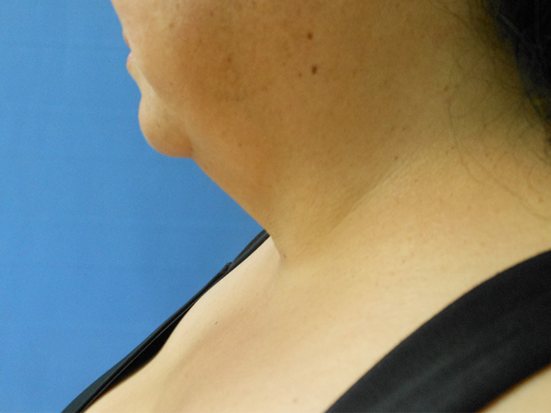 Close-up of a person's neck and chin against a blue background
