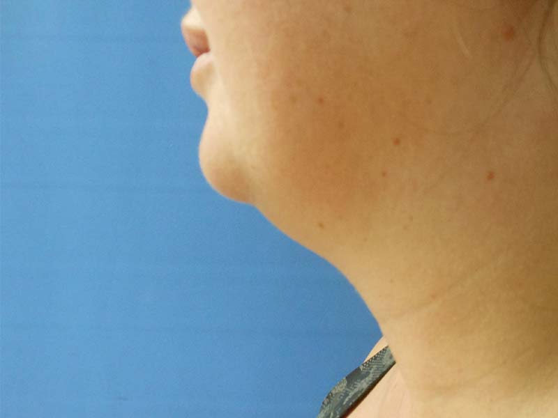 Profile view of a woman's neck and chin against a blue background