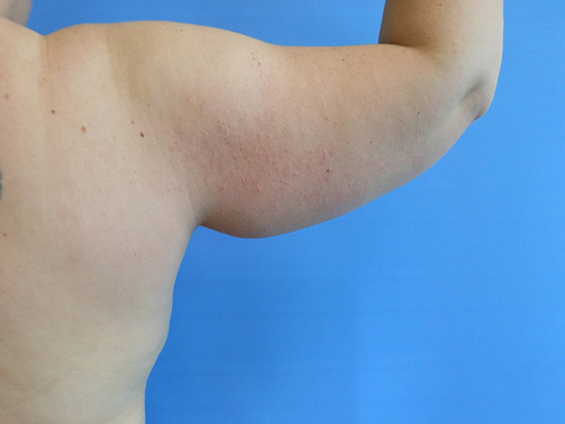 A close-up of a bare upper arm and shoulder against a blue background