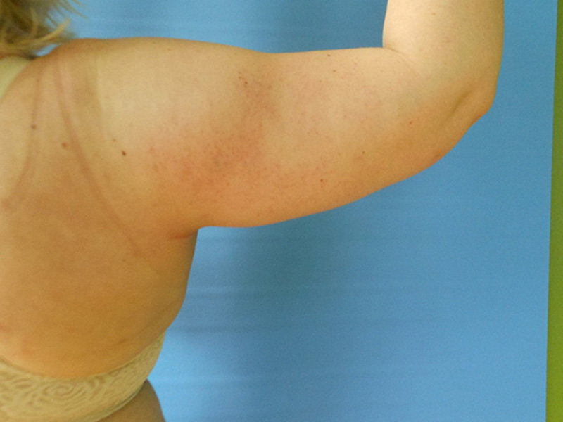 A person's bare upper arm is raised against a blue background