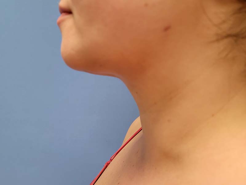 Profile view of a person’s neck and jawline against a blue background