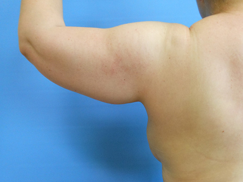 Close-up of a bare arm with visible muscle definition against a blue background