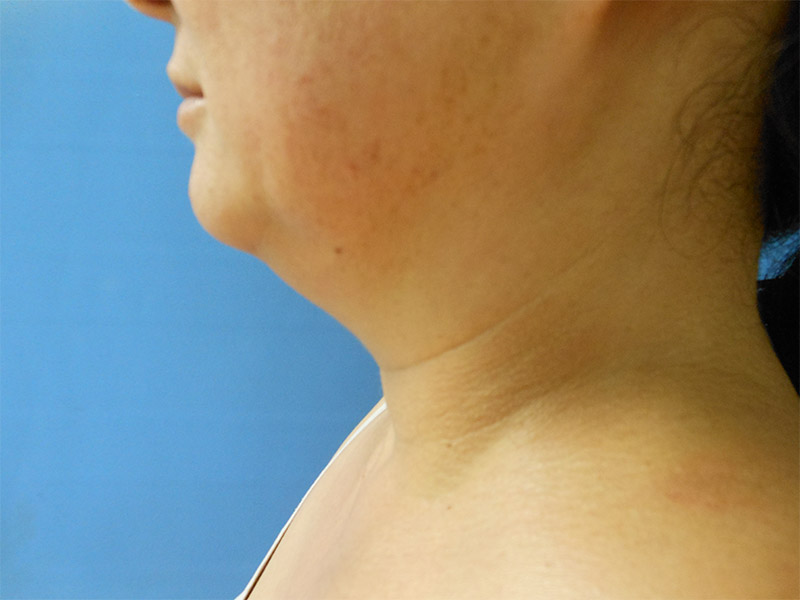 Close-up of a person's neck and chin against a blue background