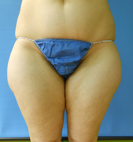 Person standing with bare legs, wearing blue fabric bikini bottom, in front of a blue background