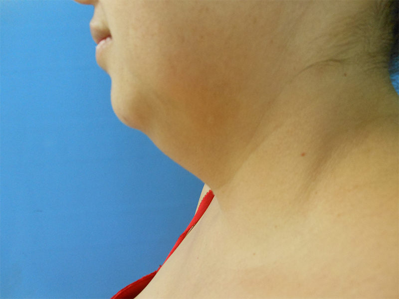 Side profile of a person's neck and chin against a blue background