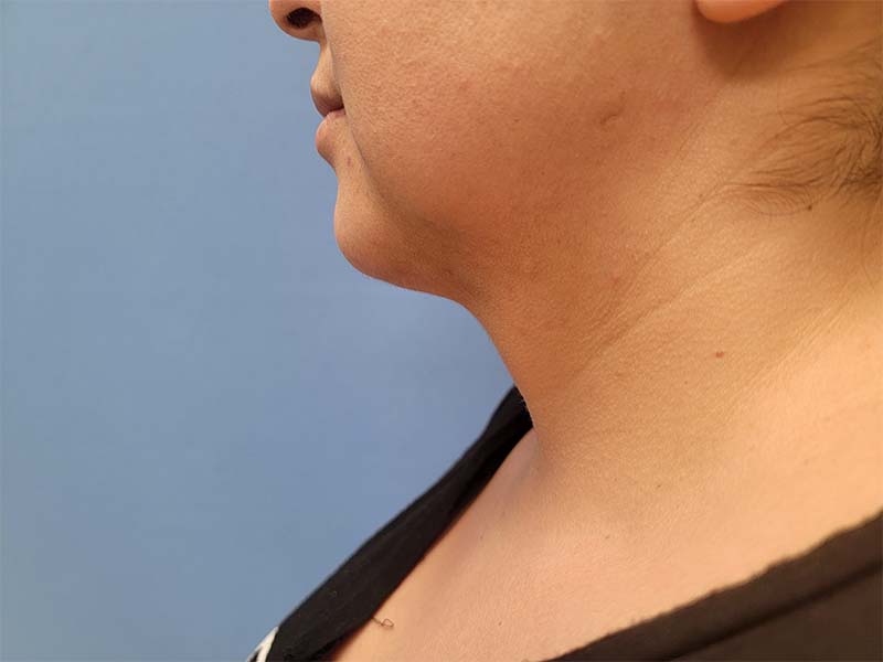Profile view of a person’s neck and jawline against a blue background