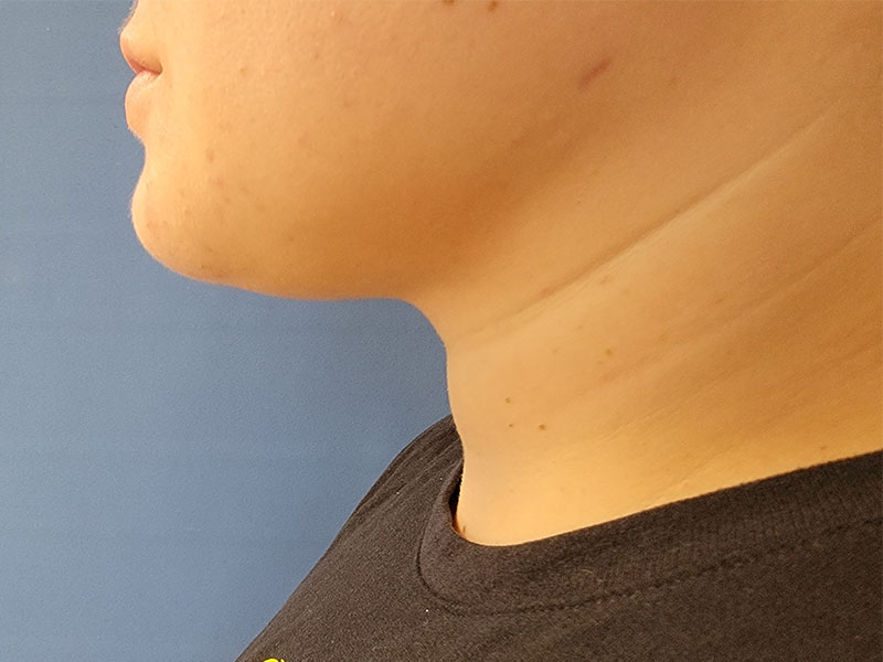 Profile view of a person's neck and jawline against a blue background