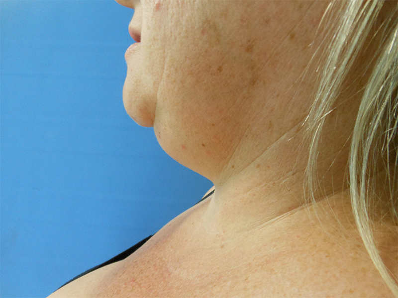 Side view of a person's neck and shoulder against a blue background