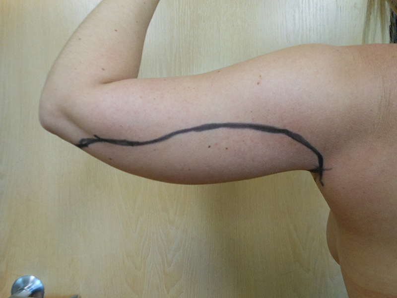 A human arm with a black line drawn along the length of the upper arm