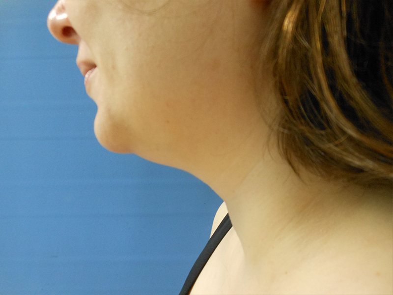 Profile view of a woman’s face and neck against a blue background
