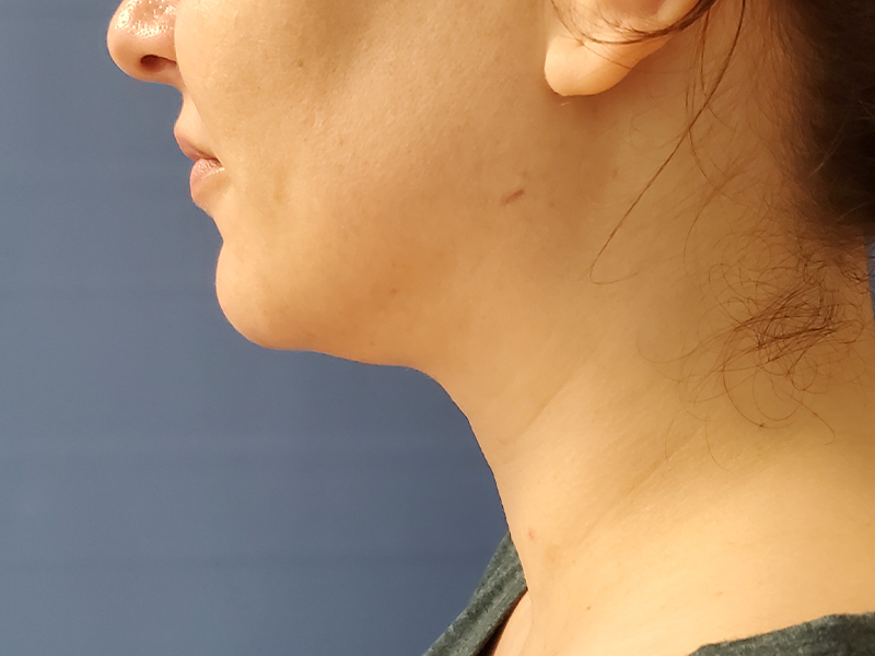 Profile view of a woman's face and neck against a blue background