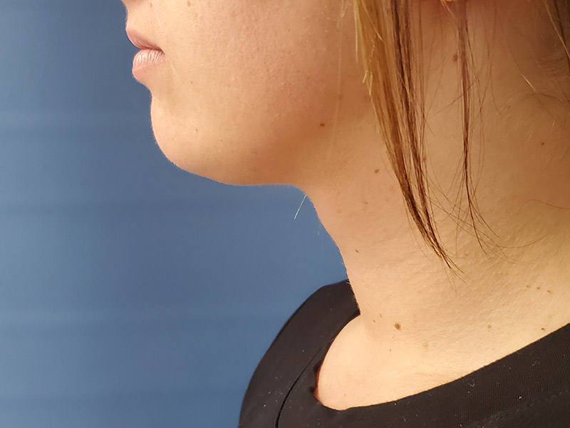 Profile view of a person’s neck and jawline against a blue background