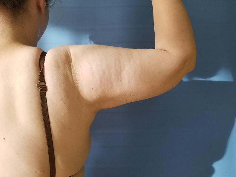 A close-up of a woman's bare arm, showing skin texture against a blue background