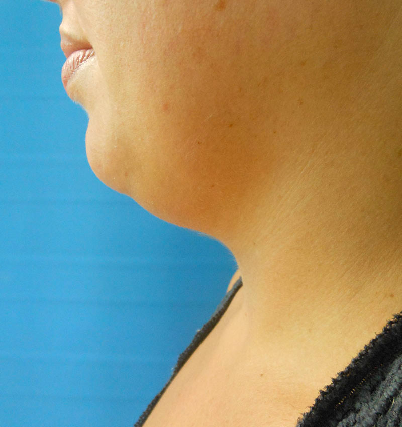 Profile view of a person’s neck and chin against a blue background