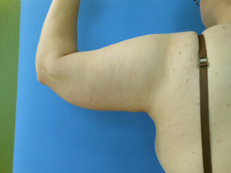 Close-up of a bare upper arm with visible skin texture against a blue background