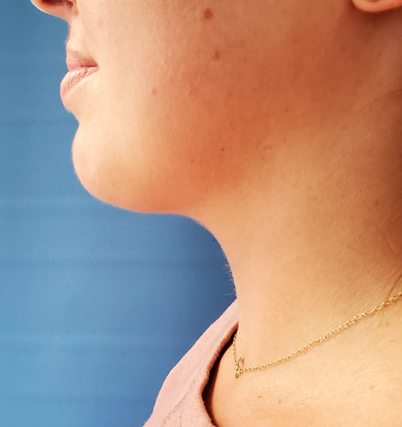 Profile view of a person's neck and chin against a blue background