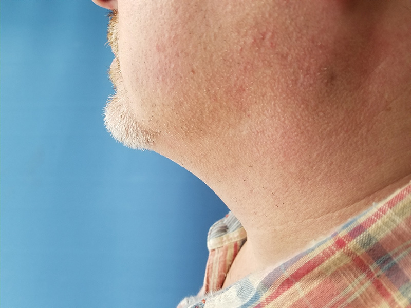 Side view of a person's jawline and neck against a blue background
