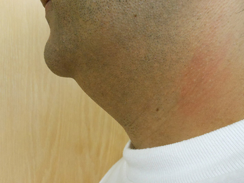 Close-up of a man's jawline and neck with slight redness against a light background