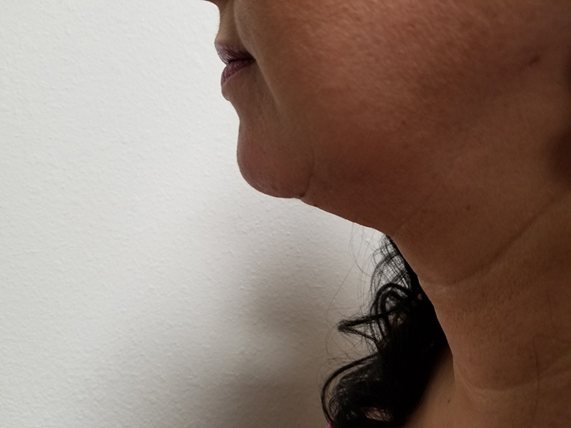 Profile view of a woman's face, showing her chin and neck against a plain background
