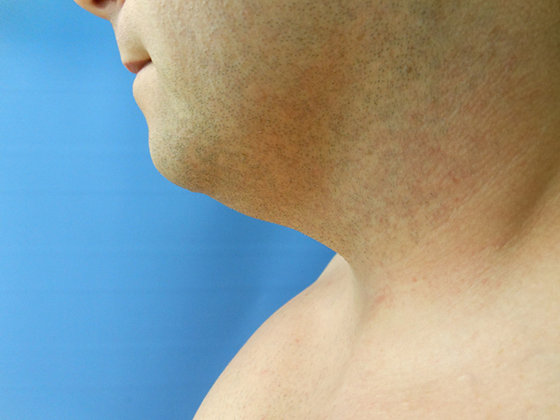 Profile of a person's neck and jawline against a blue background