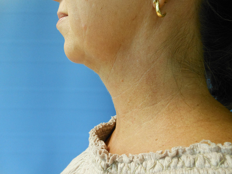 Profile view of a woman's neck and shoulder against a blue background