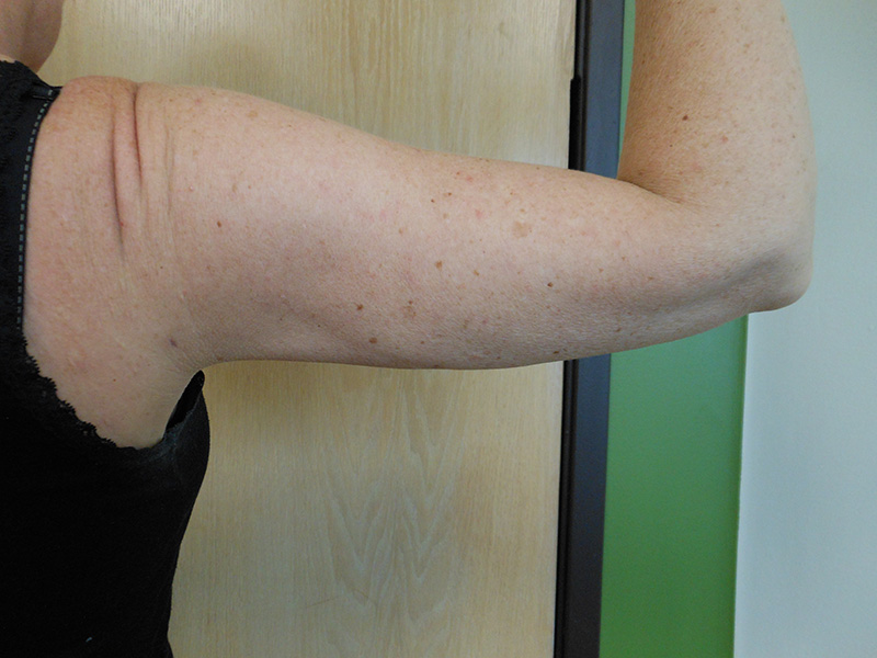 A close-up of a bare arm with visible freckles, stretched against a wall