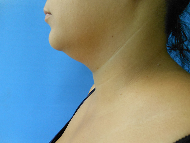 A side view of a person's neck and jawline against a blue background