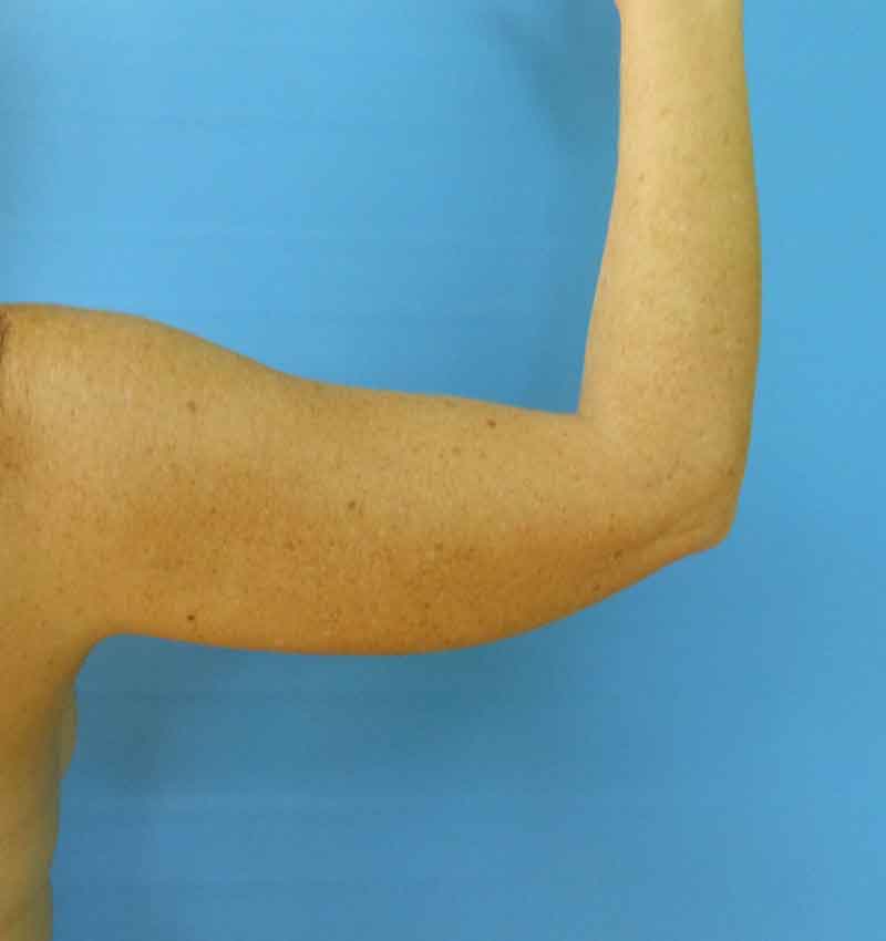 A nude arm raised against a blue background, showing muscle definition