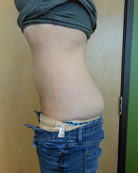 Side view of a person showing skin with stretch marks and low-rise jeans