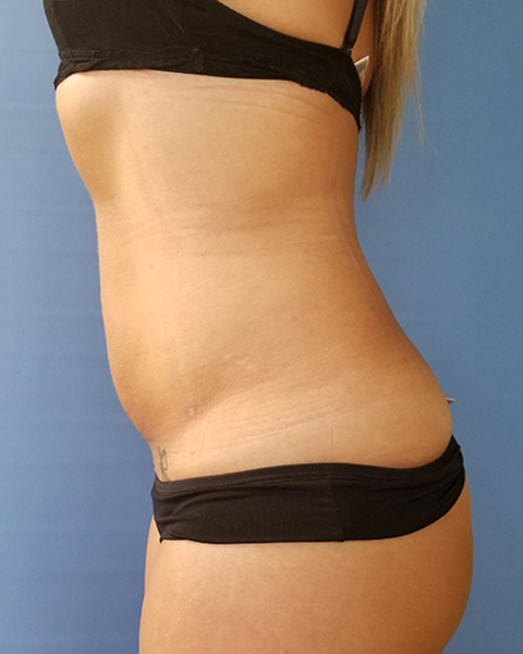 Side view of a person wearing black underwear, showing visible skin texture and marks on the abdomen