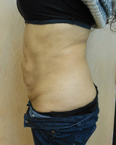 Side view of a person's torso with visible skin folds and a waistband