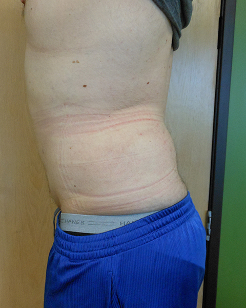 Side view of a torso with red marks on the skin near the waist, standing against a wall