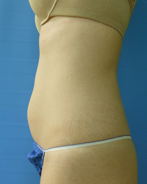 Side view of a torso showing skin with stretch marks and a blue garment