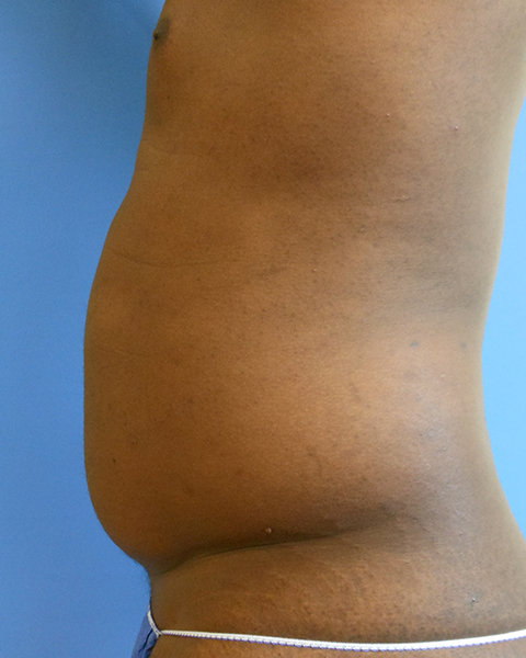 Side view of a torso with noticeable abdominal protrusion against a blue background