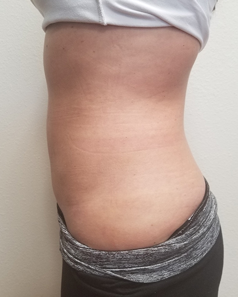 Side view of a torso showing skin with stretch marks, wearing a fitted top and pants