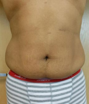 Close-up of a person’s bare torso showing a flat stomach and belly button, wearing striped underwear