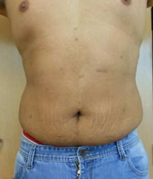 A close-up view of a bare torso with visible stretch marks and wearing blue jeans