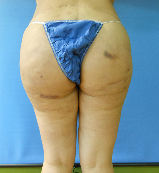 Person's back view in blue underwear against a blue background. Bruises are visible on skin