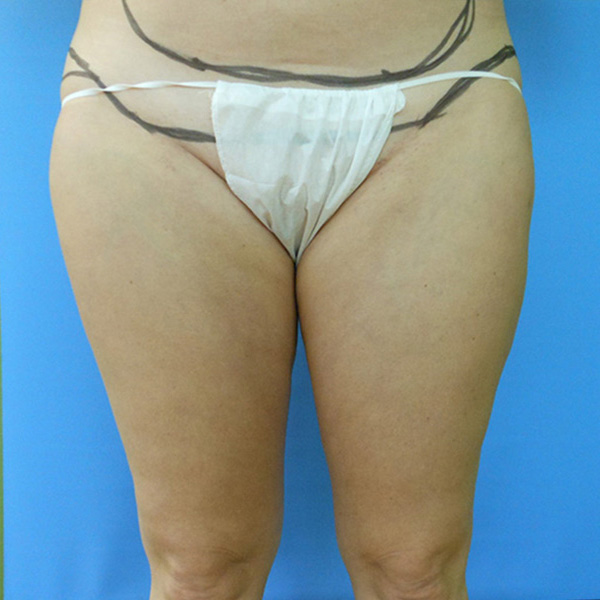 A close-up of a person's lower body wearing beige undergarments against a blue background
