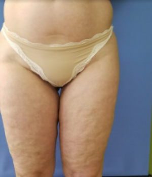 Close-up of a person's thighs wearing beige underwear against a blue background