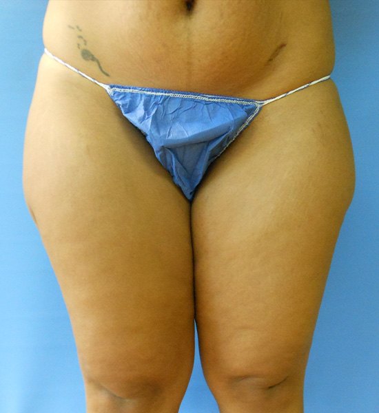 Person standing with blue underwear, facing forward against a blue background