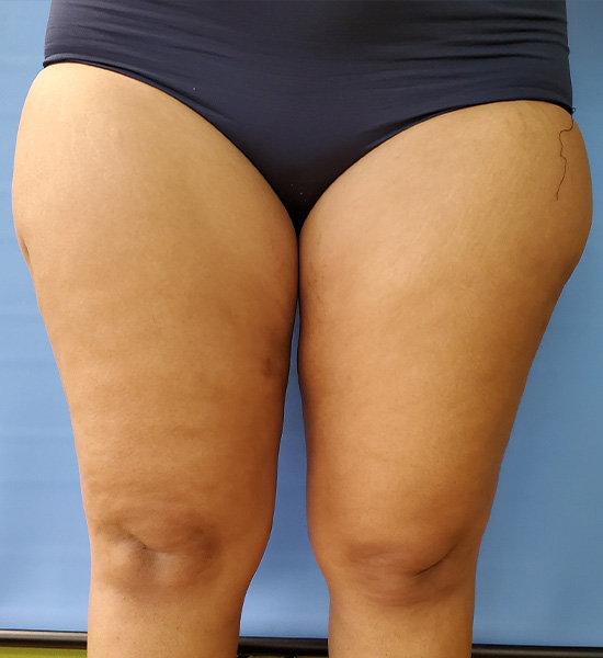 Close-up of two thighs with visible skin texture and stretch marks, against a blue background