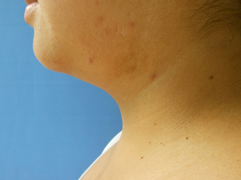 Side view of a person’s neck with some skin blemishes and a blue background