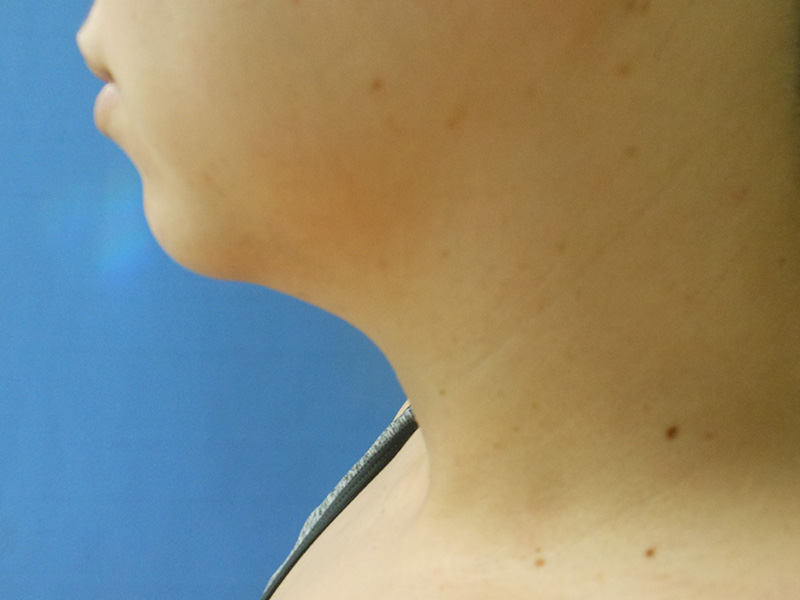Close-up of the side of a person's neck and chin against a blue background