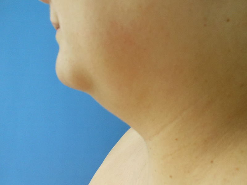 Profile view of a person's neck and jawline against a blue background